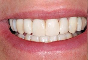 Zen Dentistry | Sports Mouthguards, Teeth Whitening and Dental Bridges