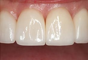Zen Dentistry | Porcelain Veneers, Root Canals and Oral Cancer Screening