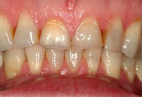 Zen Dentistry | Crowns, Periodontal Treatment and Gum Therapy